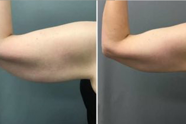 Read more about the article Does CoolSculpting Work on Arms? [A Deeper Look]