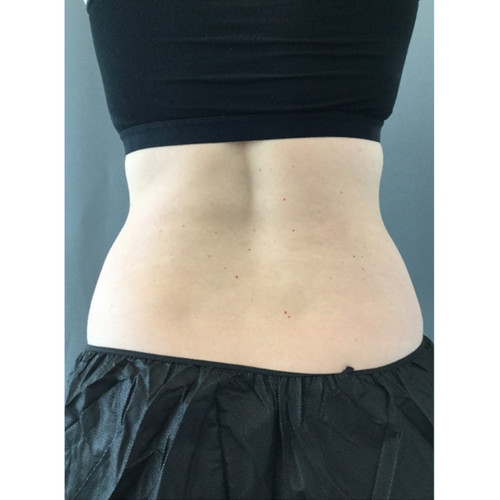 CoolSculpting-13-after-resized