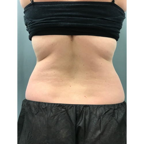 CoolSculpting-13-before-resized