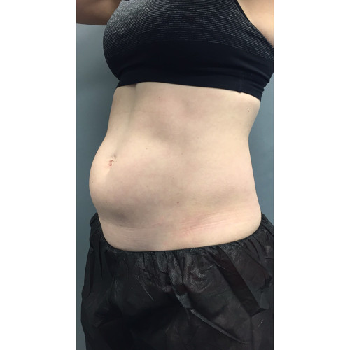 CoolSculpting-14-before-rezsized