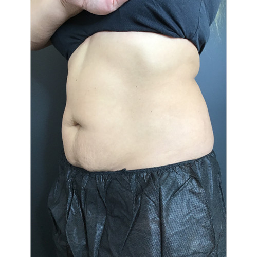 CoolSculpting-15-after-rezsized