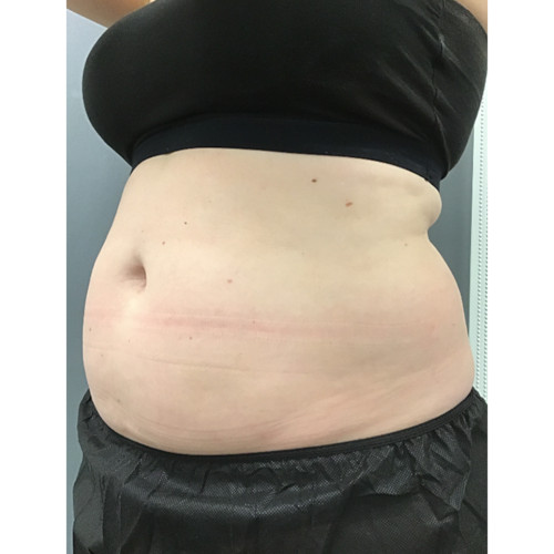 CoolSculpting-16-before-rezsized