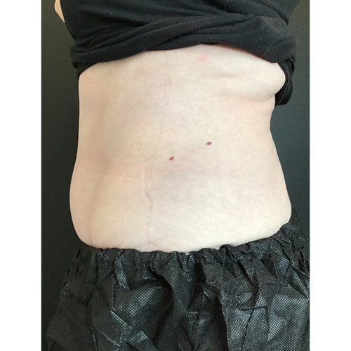 CoolSculpting-17-after-rezsized