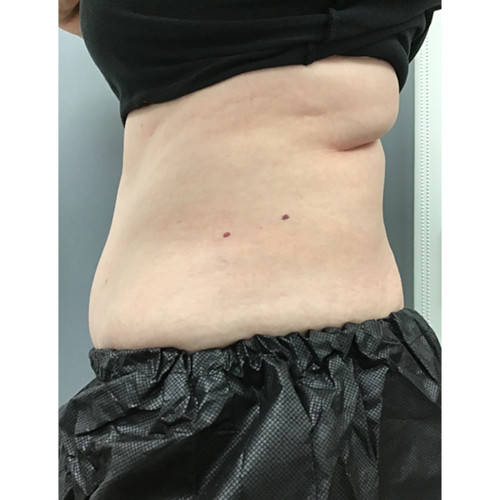 CoolSculpting-17-before-rezsized