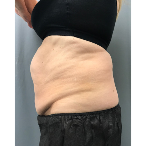 CoolSculpting-24-after-resized