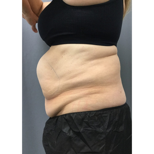 CoolSculpting-24-before-resized
