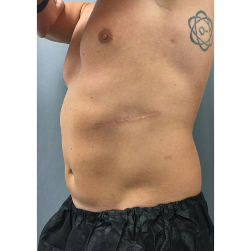CoolSculpting-25-after-resized