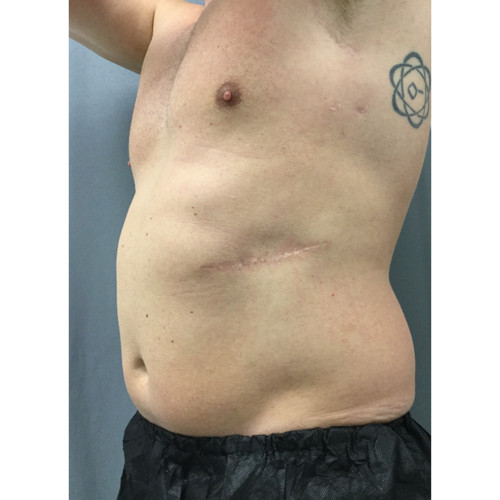 CoolSculpting-25-before-resized
