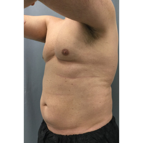 CoolSculpting-26-after-resized
