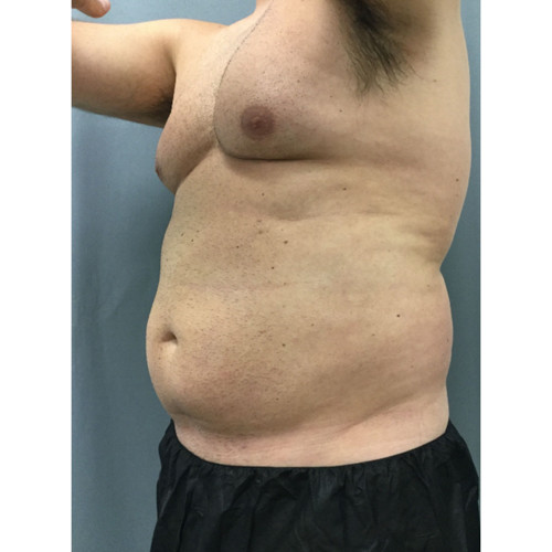 CoolSculpting-26-before-resized