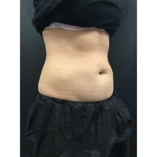 CoolSculpting-27-after-resized