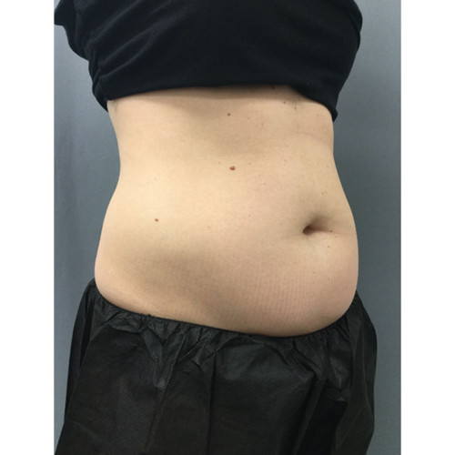 CoolSculpting-27-before-resized