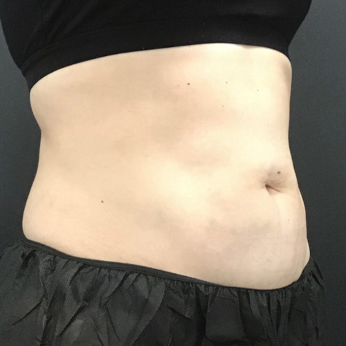 CoolSculpting-After-12-resized