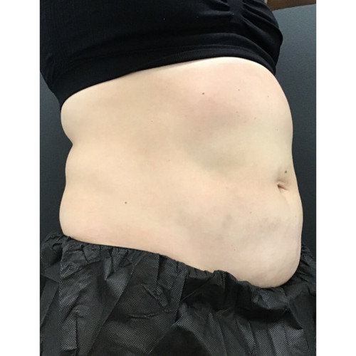CoolSculpting-Before-12-resized
