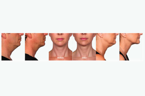 Read more about the article What is Kybella?